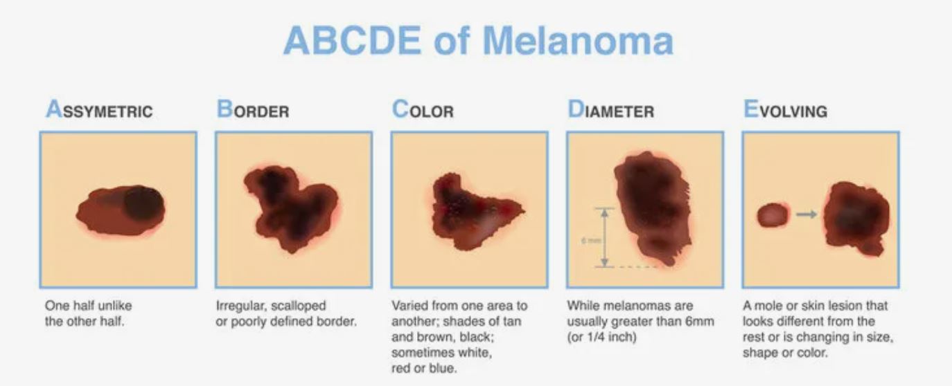 ABCD melanoma - na kaj je potrebno biti pozoren Vir: dezen.ru, Telegram ABCD melanoma - na kaj je potrebno biti pozoren Vir: dezen.ru, Telegram