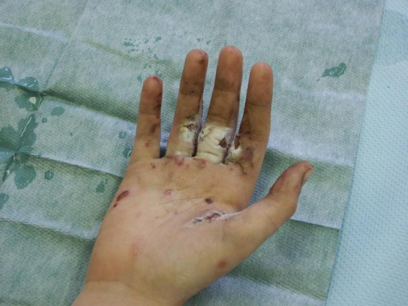 Ob prehodu v novo leto pri eksploziji pirotehničnega izdelka hudo poškodovan 28-letnik