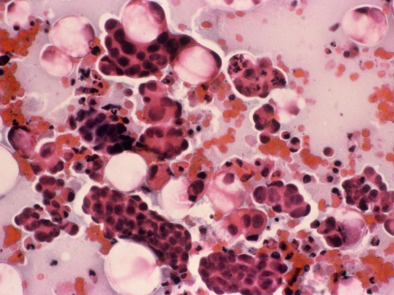 Število novoodkritih rakov na materničnem vratu se je prepolovilo