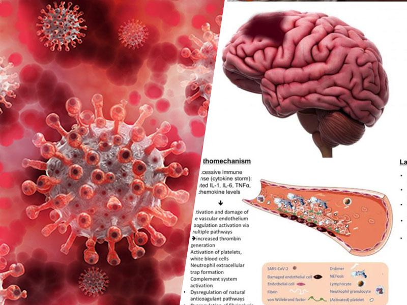 Presenetljivo spoznanje ameriških zdravnikov: Novi koronavirus ni respiratorna infekcija, pač pa bolezen ožilja