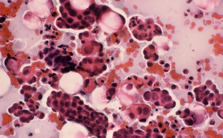 Rak na materničnem vratu